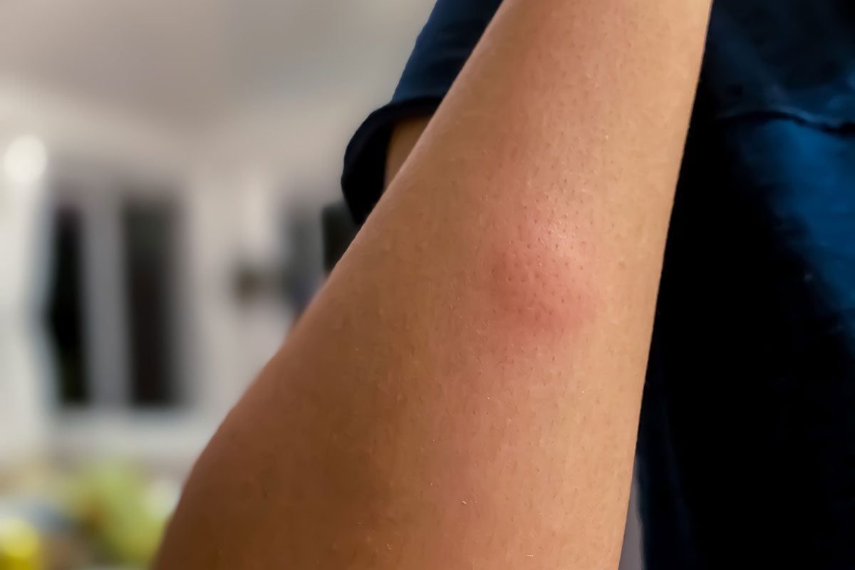 A bare arm shows a red, raised area, indicating irritation. The background features a blurred indoor environment with soft lighting.