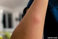 Rapid Relief from Mosquito Bites