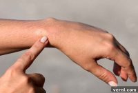 How to Treat a Wasp Sting: Quick Action Steps