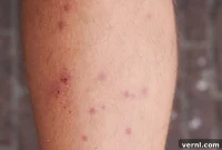 Essential Facts About Mite Bites
